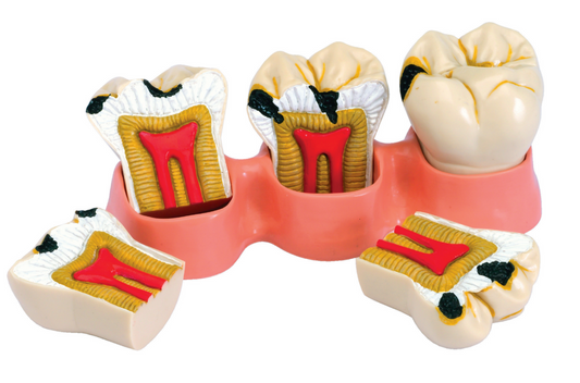 Mod. Estados Da Caries – Dental Store